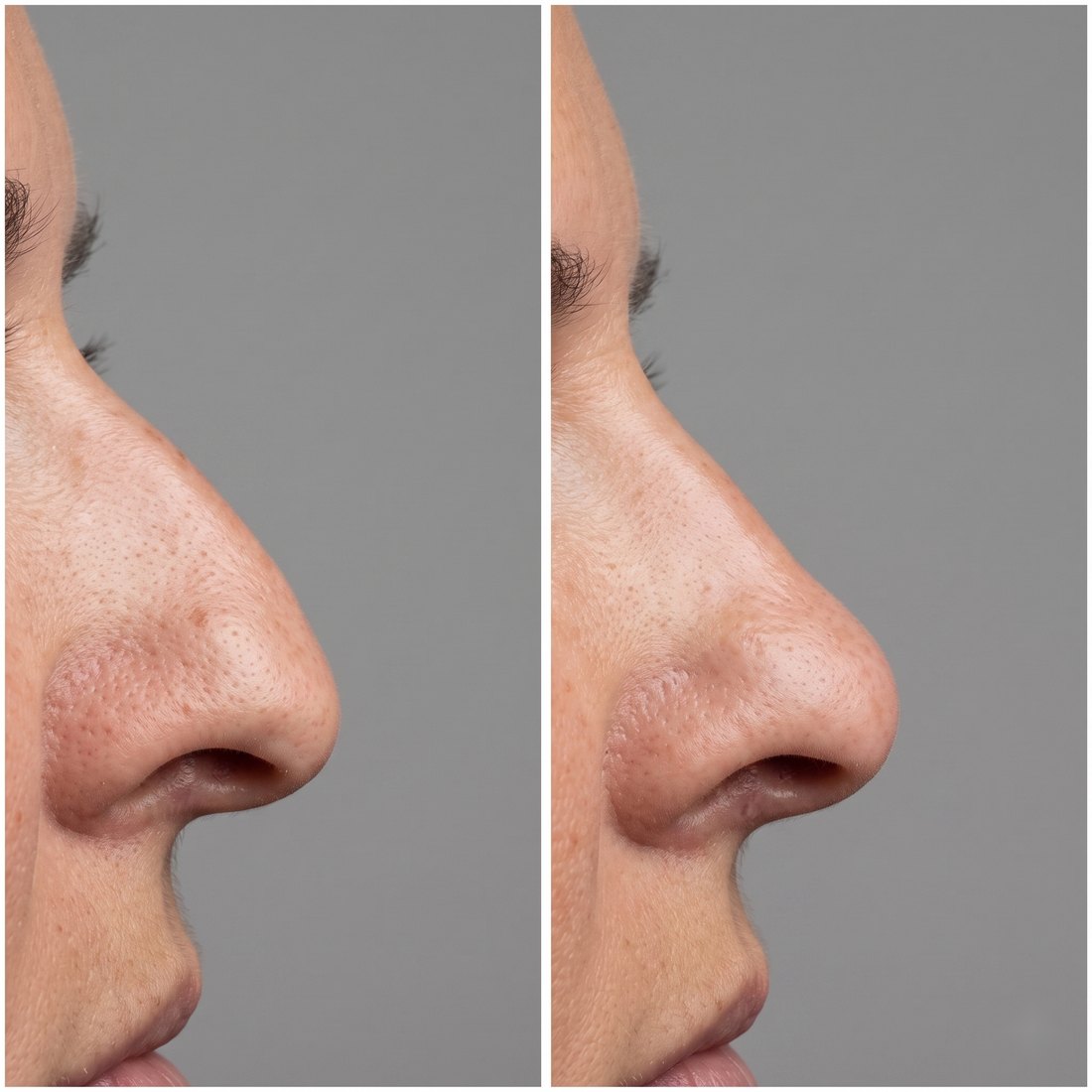 Antes y después de rinomodelación con ácido hialurónico, perfil