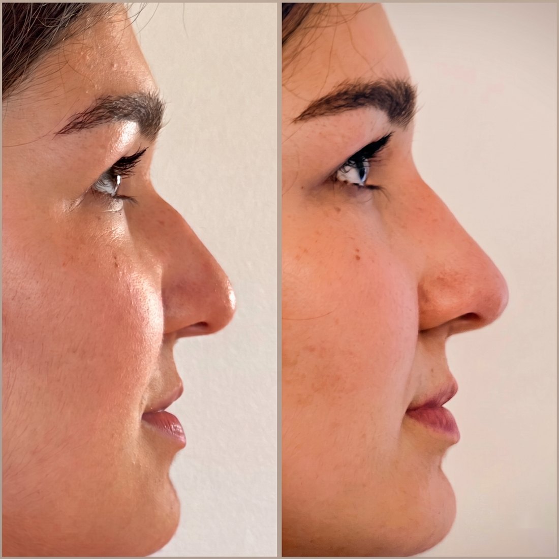 Antes y después de rinomodelación con ácido hialurónico, perfil
